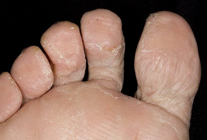 Сыпь между пальцами ног, и на верхней части стопы