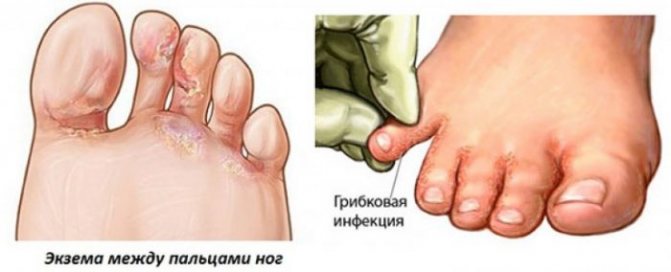 Сыпь между пальцами ног, и на верхней части стопы