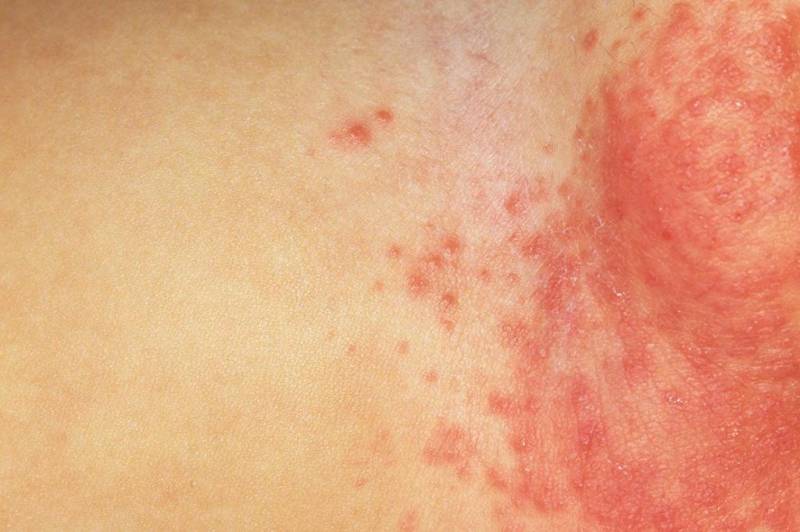 Rash in the groin of a child: causes