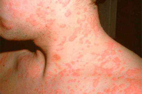 тепловая аллергия