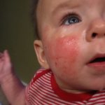 У малыша на щеках аллергия