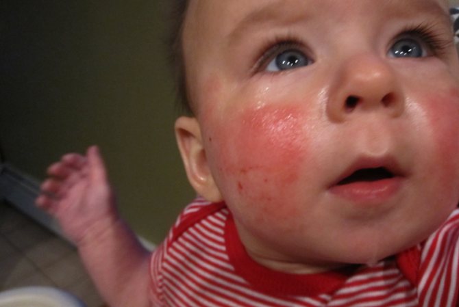 У малыша на щеках аллергия