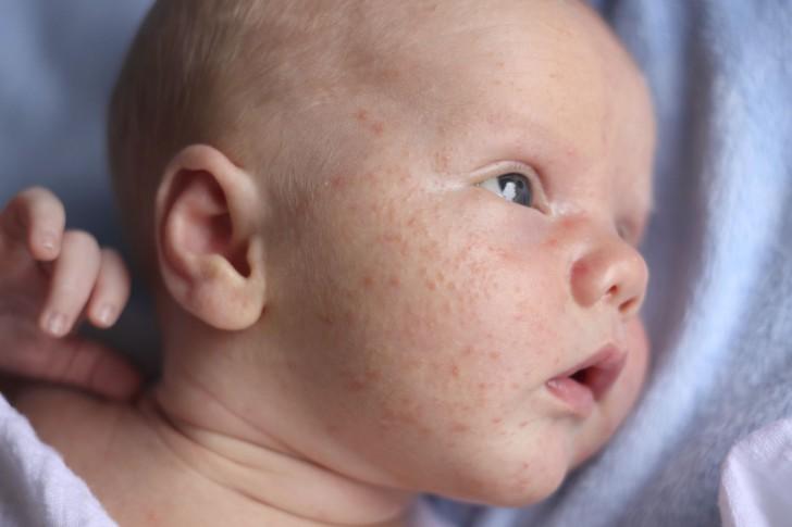 У ребенка мелкая сыпь на лице, по каким причинам может появляться