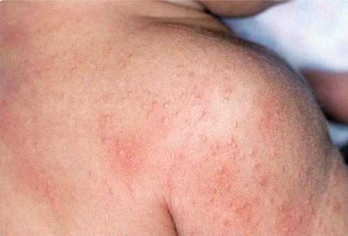 Виды аллергического дерматита