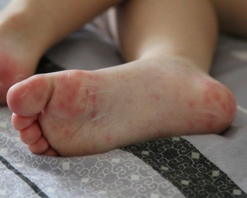 Types of rashes, rashes and spots on the heels and feet. Causes and treatments 