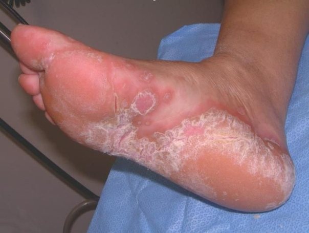 Types of rashes, rashes and spots on the heels and feet. Causes and treatments 
