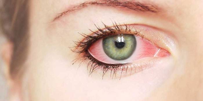 A girl&#39;s inflamed eye
