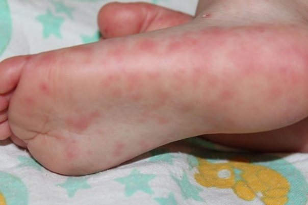 Rashes on the feet of a child