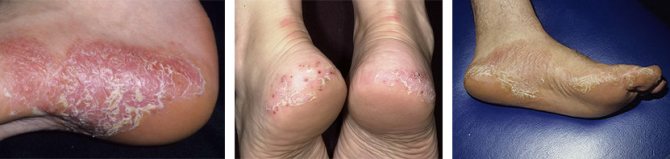 Ювенильный ладонно-подошвенный дерматоз фото на ступнях