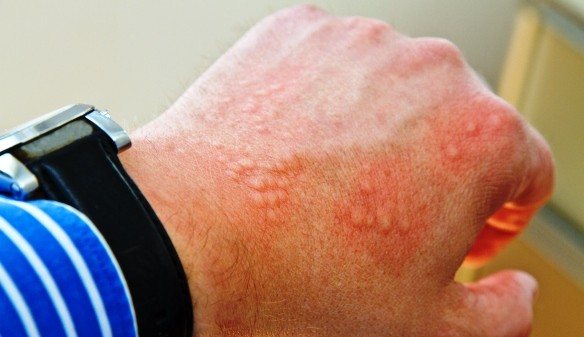 Itchy hands with dyshidrotic dermatitis
